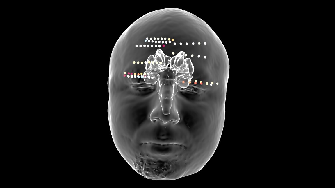 Depth Electrodes displayed on 3D rendered brain with real outer skin display taken from MRI scan.