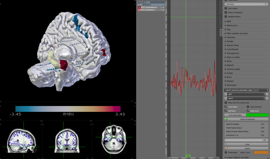 Depth electrodes with 3D brain display showing data from selected electrode and the closest areas on the brain to that electrodes. Including interactive MRI scans.
