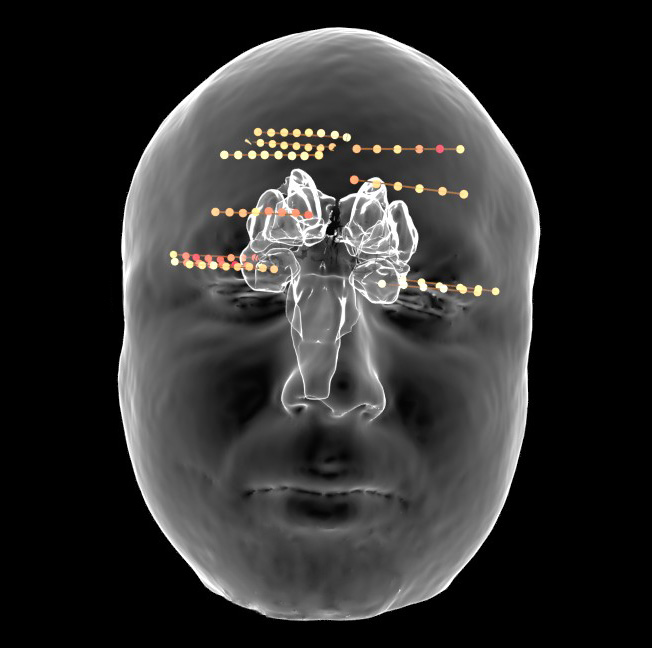 Depth Electrodes displayed on 3D rendered brain with real outer skin display taken from MRI scan.