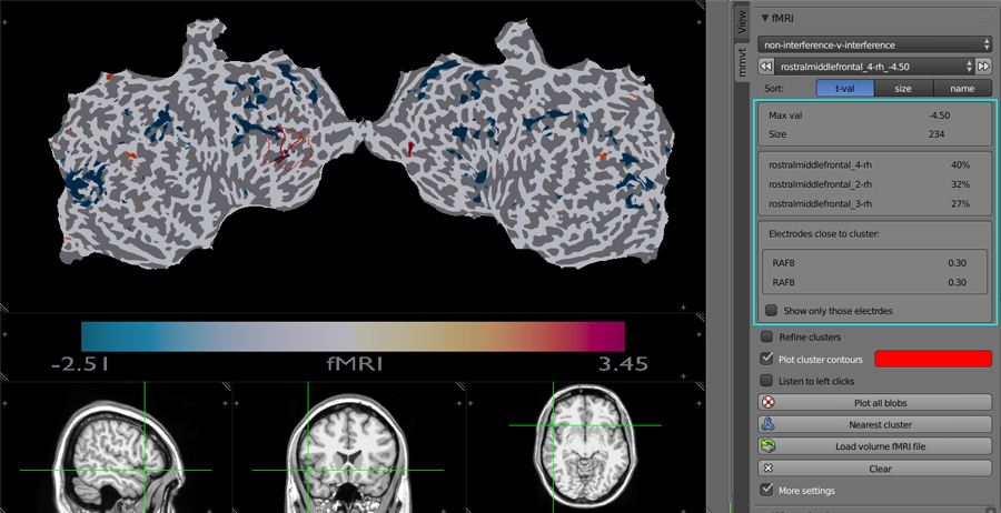 fMRI flat brain with information about the selected blob's clusters and interactive MRI scans display.