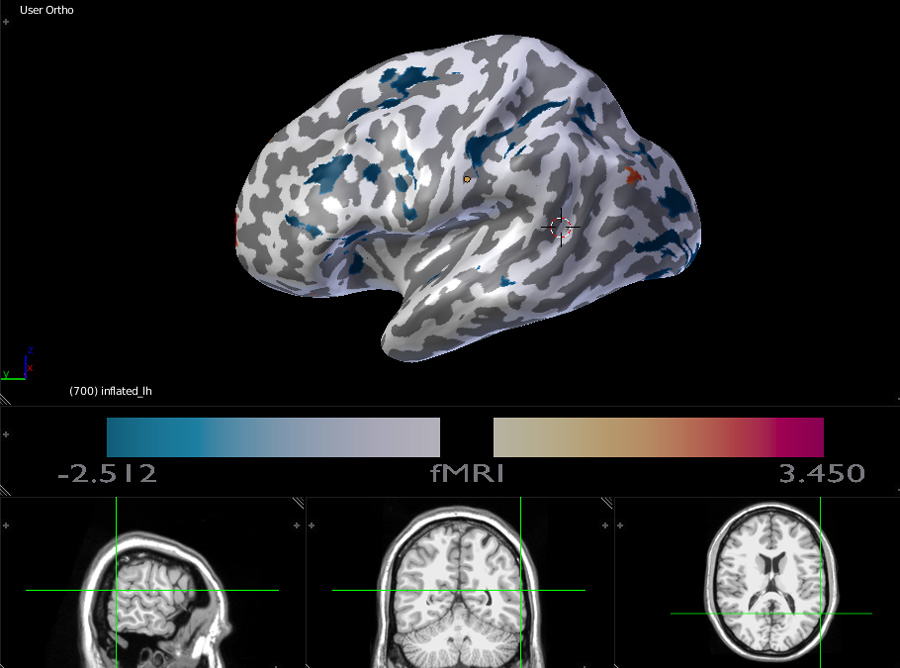 fMRI 3D inflated brain with cotumized color bar and interactive MRI scans display.