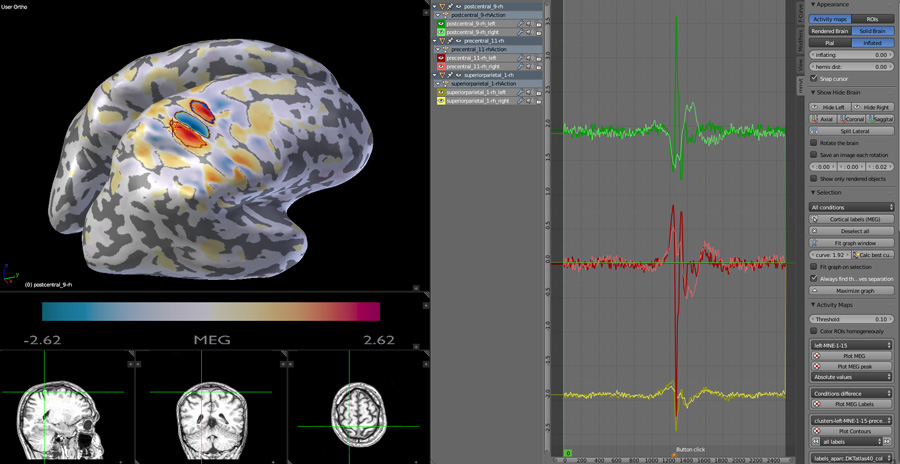 MEG clusters data on infalted brain with MRI display