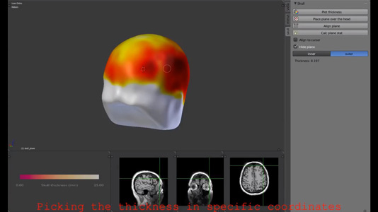 MMVT skull thickness video thumbnail