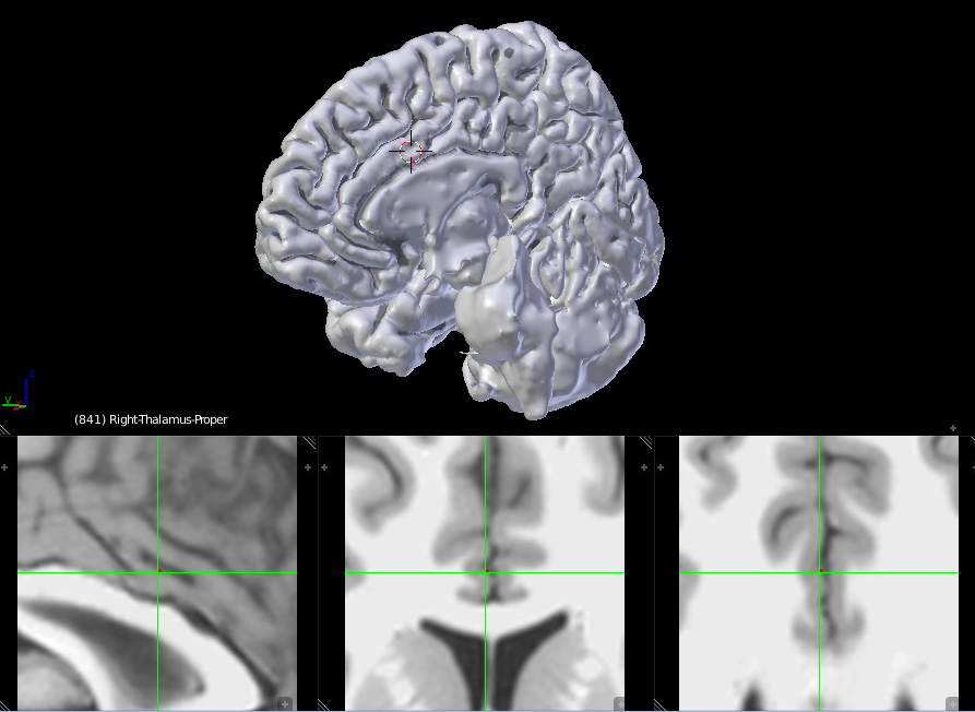 Neuroanatomy 3D brain with zoom around selected area on the MRI display
